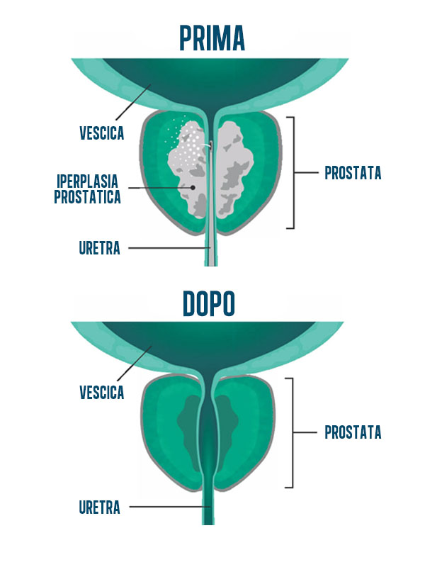 rezum prostata italia)