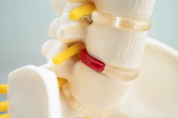 ernia-del-disco-visita-neurochirurgica-fiorenzuola-neurochirurgo