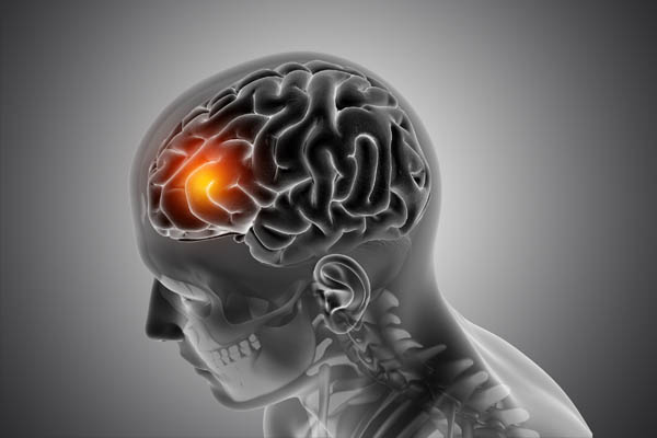 tumore-cerebrale-visita-neurochirurgica-fiorenzuola-neurochirurgo